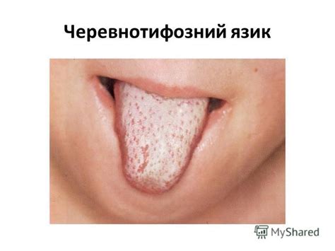 Презентация на тему: "Лекція 3 Черевний тиф. Черевний тиф – це гостра ...