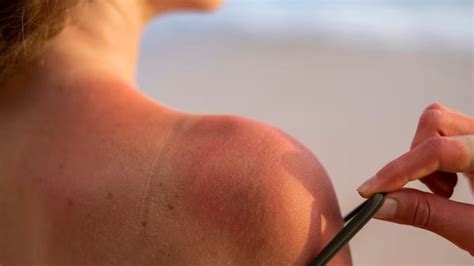 Quanto Tempo Dura Queimadura De Sol - Quanto tempo dura uma queimadura de sol e o que fazer para agilizar?