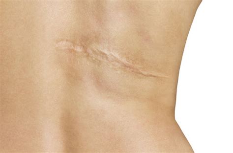 Preventing scars after a burn wound - ALHYDRAN CO UK