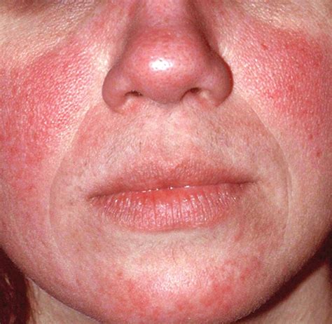 rosacea kinn rosacea papulopustulosa  ist das ebrx