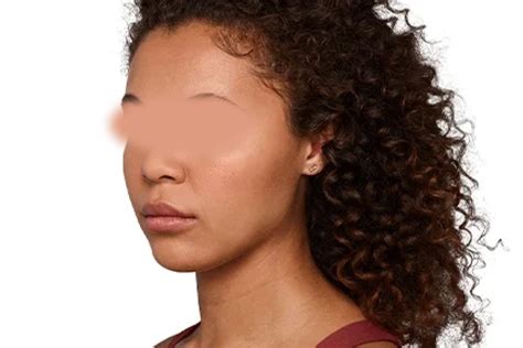 Jawline in Paris | Aesthetic Medicine | Skin Marceau Clinic