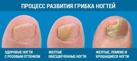Мази и крема против грибка ногтей на ногах