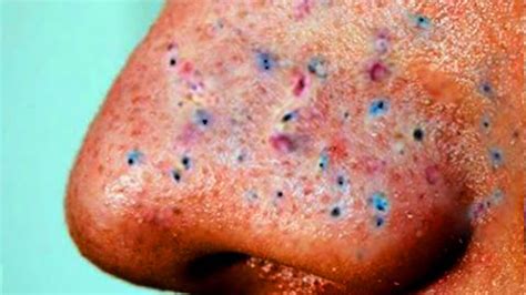 24 Beautiful Blackheads Hurt - All About Blackheads