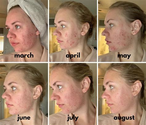 Tretinoin Sun Damage Cream (Retin-A) | ubicaciondepersonas.cdmx.gob.mx