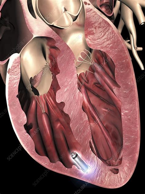 Leadless pacemaker in anterior heart - Stock Image - C025/5232 ...