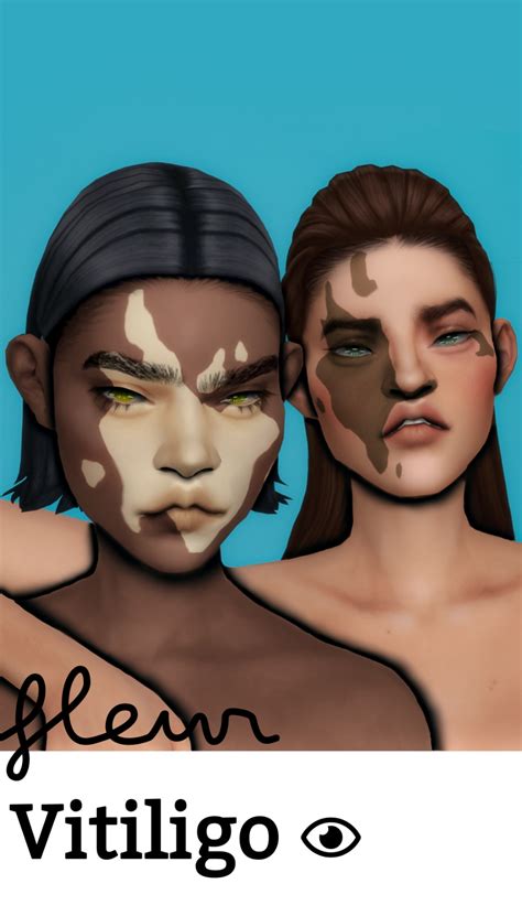 Vitiligo by ayoshi sims the sims 4 – Artofit