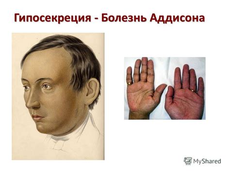 Болезнь Аддисона фото