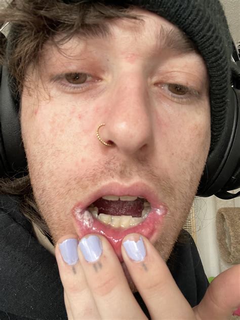 Tongue hurts like crazy and corners of my mouth and inside of mouth are
