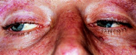 Acute hepatitis | The BMJ