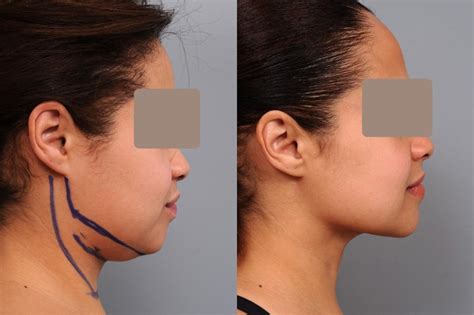 face liposuction