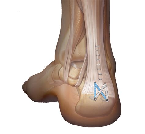 insertional achilles tendonitis orthotics  aidan zichy woinarski blog