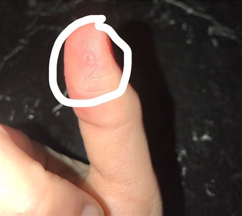 Is this a wart? It’s starting to become painful and larger…. : r/Warts