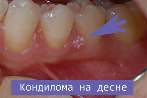 Папиллома во рту у ребенка фото