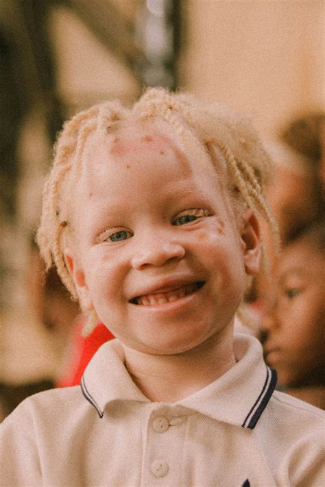 Albinism Wallpapers - Wallpaper Cave