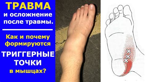 Травма и Триггерные точки. Как появляются триггеры в мышцах? - YouTube