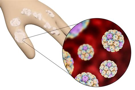hpv symptoms treatment vaccine hpv  men  women