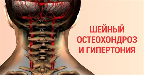 Упражнения при шейном остеохондрозе