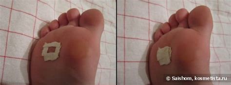 Чистотел от мозолей со стержнем на стопе: лечение и удаление