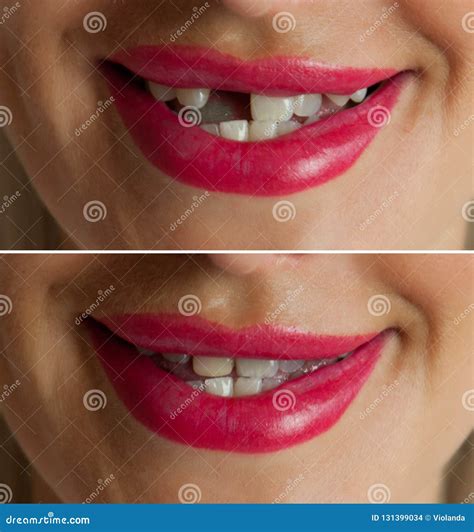 how to fix a broken tooth at home 10