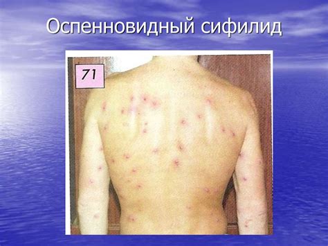 Вторичный период сифилиса. Скрытый сифилис. Серологическая диагностика ...