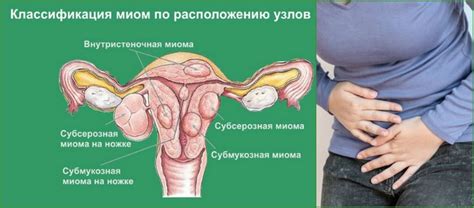 Интрамуральная миома матки: что это, лечение, особенности