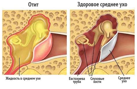 Ниотит ушные капли - инструкция по применению при отите и боли в ушах