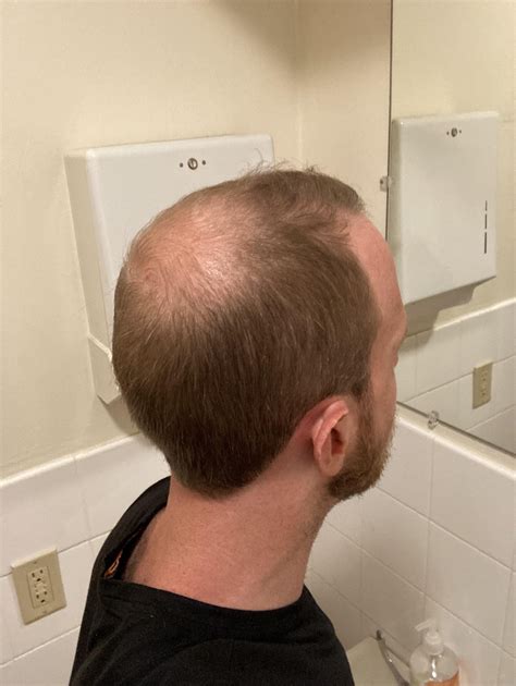 Will I look better bald? Big forehead warning! : r/bald