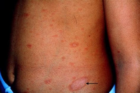 Pityriasis rosea