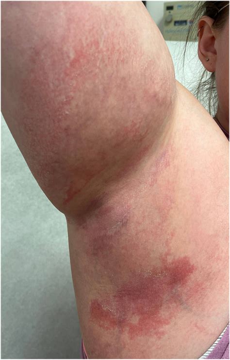 Acute generalized exanthematous pustulosis sine pustules following