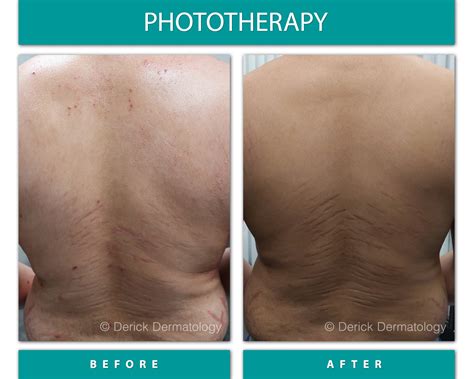 Phototherapy I BBL™ Laser Treatment Of Age Spots, Freckles, Birth