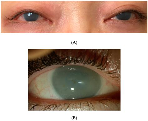 Hurler Syndrome Corneal Clouding
