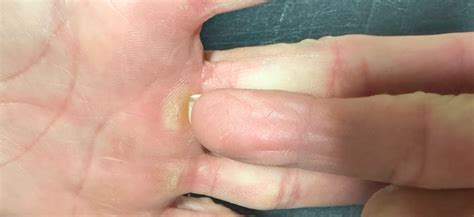 Mastering Callus Care: 3 Signs Your Calluses Need Attention – SandBar ...
