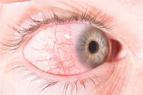 Episcleritis: Causes and Treatment | MyVision.org