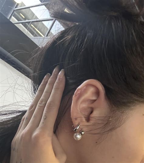 UPDATES: Surgical excision and cortisone shots : r/Keloids