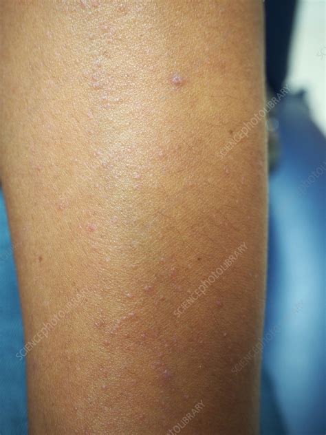 flat warts stock image  science photo library