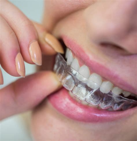Plastic Retainer Price