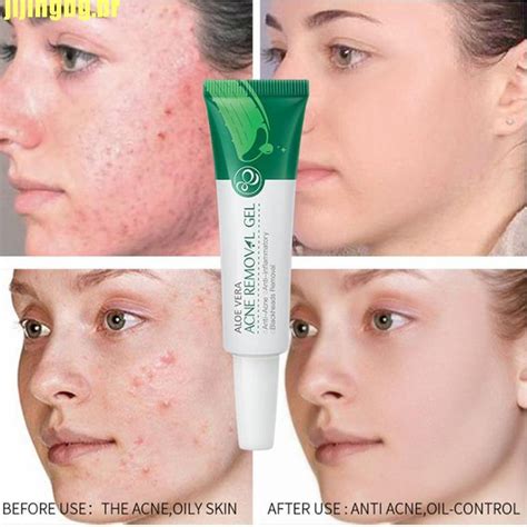 Pomada Para Espinha E Manchas - Pomada Gel Tira Manchas e Espinhas Tratamento Acne Aloe Vera | Shopee ...