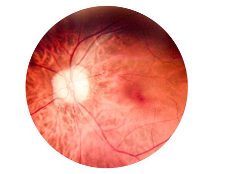 Use of Low-Dose Eylea Grows for Diabetes-Related Eye Conditions | AAO 2024