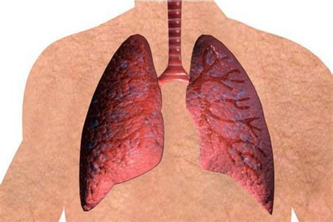 Excess of Vitamin A Supplementation give Risks of Lung Cancer | Lungs ...
