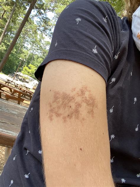 Weird skin patch that I’ve had for 5-ish years : r/DiagnoseMe