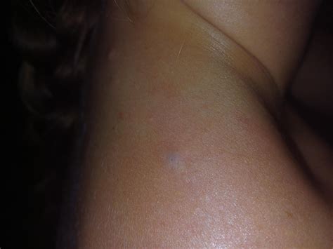 I'm this a blackhead? It won't pop and hurts : r/popping