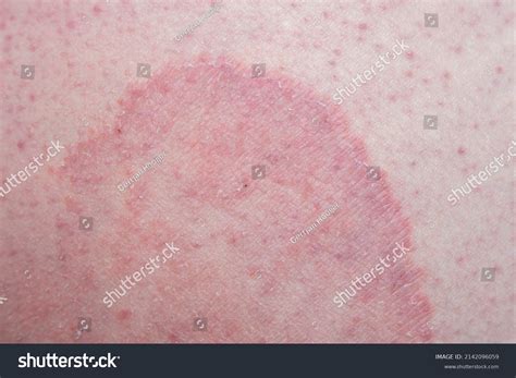 tinea cruris  jock itch common foto stock  shutterstock
