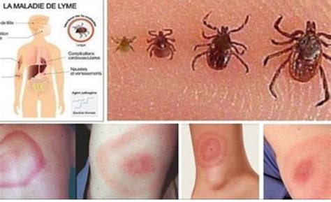 O Que É A Doença De Lyme - Doença de Lyme: tudo sobre ela