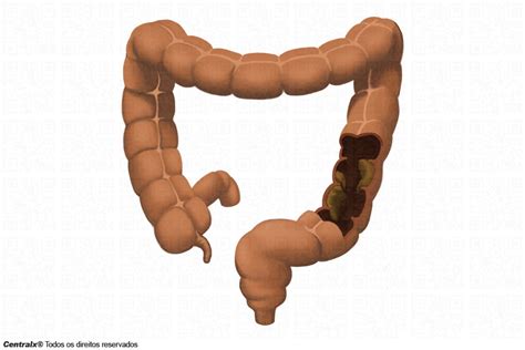 O Que É Fecaloma No Intestino - Fecaloma: o que é isso? - Sinais, Sintomas e Doenças > AbcMed