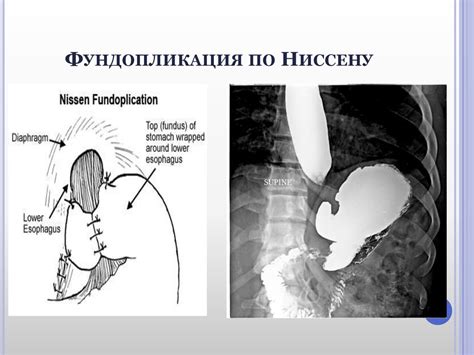 Грыжи пищеводного отверстия диафрагмы - презентация онлайн