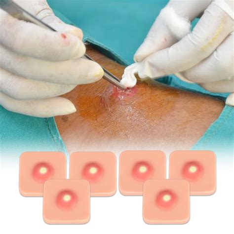 Mua Ultrassist Abscess I&D Incision and Drainage Pad (6-Pack