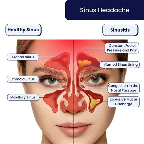 Sinusitis Headache Symptoms