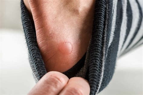 treat  blister  callus   needed guide   runners