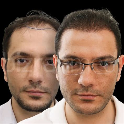 Turkish Hair Transplant, Cost In Dubai, Abu Dhabi, Sharjah, UAE | Bizrahmed