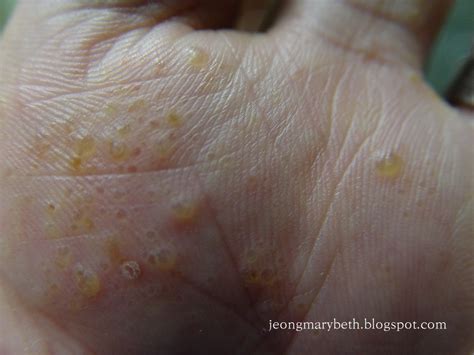 정종영과 메어리벳 : 한포진의 임상 소견 Clinical Features of Pompholyx